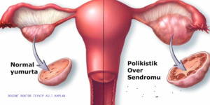 Polikistik Over Nedir