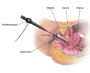 histeroskopi ankara