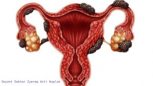 çikolata kisti nedir